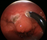 ράβδος διαμέτρων PLA402 Tonsilectomy 4.4mm για την ιατρική χειρουργική επέμβαση