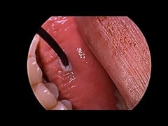 Συσκευή Ραδιοσυχνοτήτων Πλάσματος για τη Θεραπεία του Ροχαλητού με Πολυλειτουργικό Καθετήρα