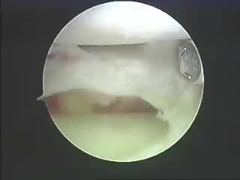 Προϊόντα αφαήρεσης συστημάτων αφαήρεσης οργάνων Electrosurgical για τη σπονδυλική στήλη και τις ενώσεις