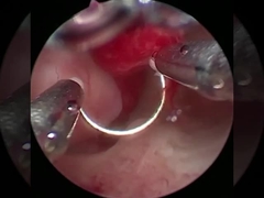 Ψυχρή Τεχνολογία Ηλεκτρόδιο Χειρουργικής Πλάσματος Για Ουρολογικές Διαδικασίες BPH