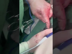 Κλινική Επατολογική Έλεγχος PLA408 για ανοιχτή χειρουργική επέμβαση