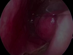 Έναχρονη υπερμικρή και ευέλικτη νευρολογική συσκευή PLA407